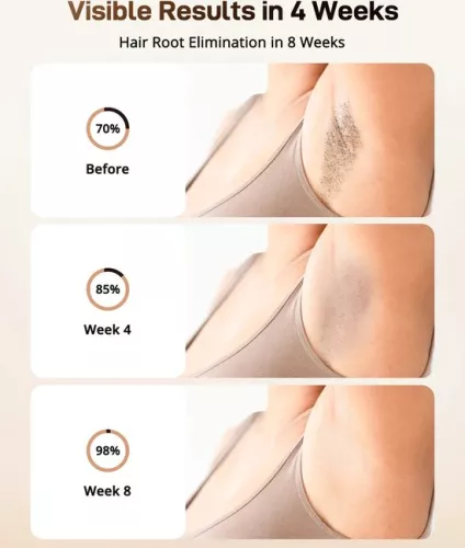 merkloos Ontharingsapparaat - Laserontharing - Ontharing - Mannen en vrouwen - Hele lichaam - Langdurige ontharing (6151011331356)