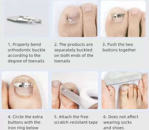 merkloos Ingegroeide teennagelcorrector (2 stuks) Roestvrijstalen paronychia-correctietool (8785306004007)