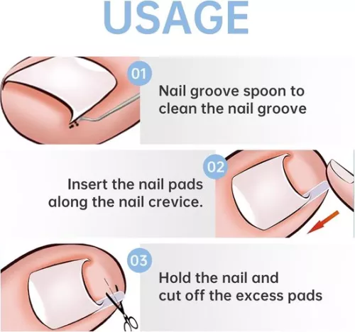 merkloos 40 stuks strips voor het gladmaken van ingegroeide teennagels, inclusief nagellifter, voor de correctie van ingegroeide teennagels. (9509465873675)