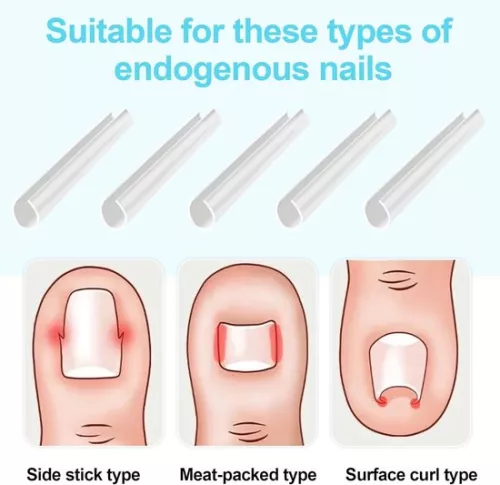 merkloos Set voor het corrigeren van ingegroeide teennagels - 40 pijnloze strips voor het gladmaken van teennagels met teennagellifter (8785322238837)