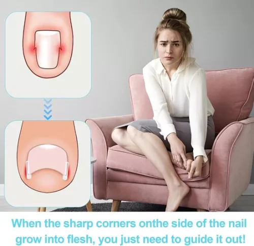 merkloos Set voor het corrigeren van ingegroeide teennagels - 40 pijnloze strips voor het gladmaken van teennagels met teennagellifter (8785322238837)