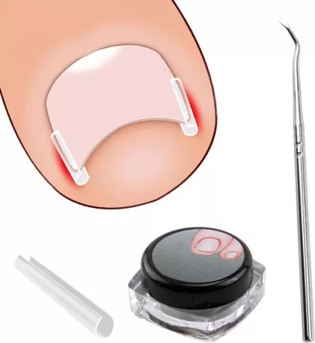 Set voor het corrigeren van ingegroeide teennagels - 40 pijnloze strips voor het gladmaken van teennagels met teennagellifter