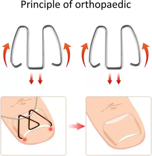 merkloos Ingegroeide teennagelcorrectiehaakje - Nagelcorrectiestrips, draadlifter voor herstel - Corrector voor dames en heren. (8785309165095)