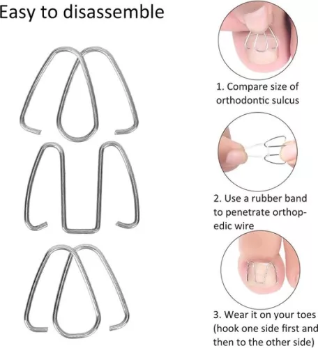 merkloos Ingegroeide teennagelcorrectiehaakje - Nagelcorrectiestrips, draadlifter voor herstel - Corrector voor dames en heren. (8785309165095)